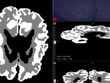 Bebek beynini analiz eden yapay zeka, erken teşhisi kolaylaştırıyor