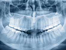 Dünyanın en çok dişe sahip erkeği: Dişlerini sayınca hayatı değişti