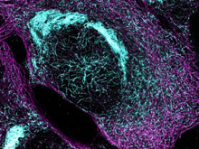 Basit bir kan testi Alzheimer'in hangi aşamada olduğunu gösterebiliyor