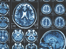 Alzheimer için dikkat çeken bulgu: Her şey beyinle ilgili değil!