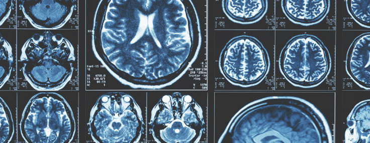 Alzheimer araştırmasında şaşırtıcı sonuç: Karbon dioksit beyindeki zararlı proteinleri azaltabilir