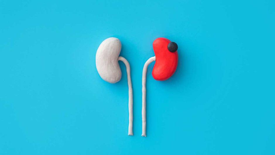 Böbrek kanseri nedir? Soru ve cevaplarla böbrek kanseri...